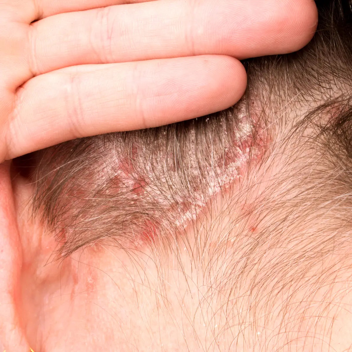 Herbal Remedies for Psoriasis: How QICAOGANGMU Aligns with Traditional Chinese Medicine (2026)