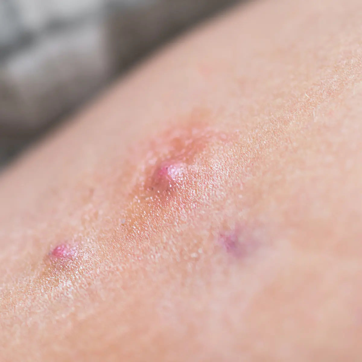 Hidradenitis Suppurativa: QICAOGANGMU for Natural Inflammation Relief (2026)