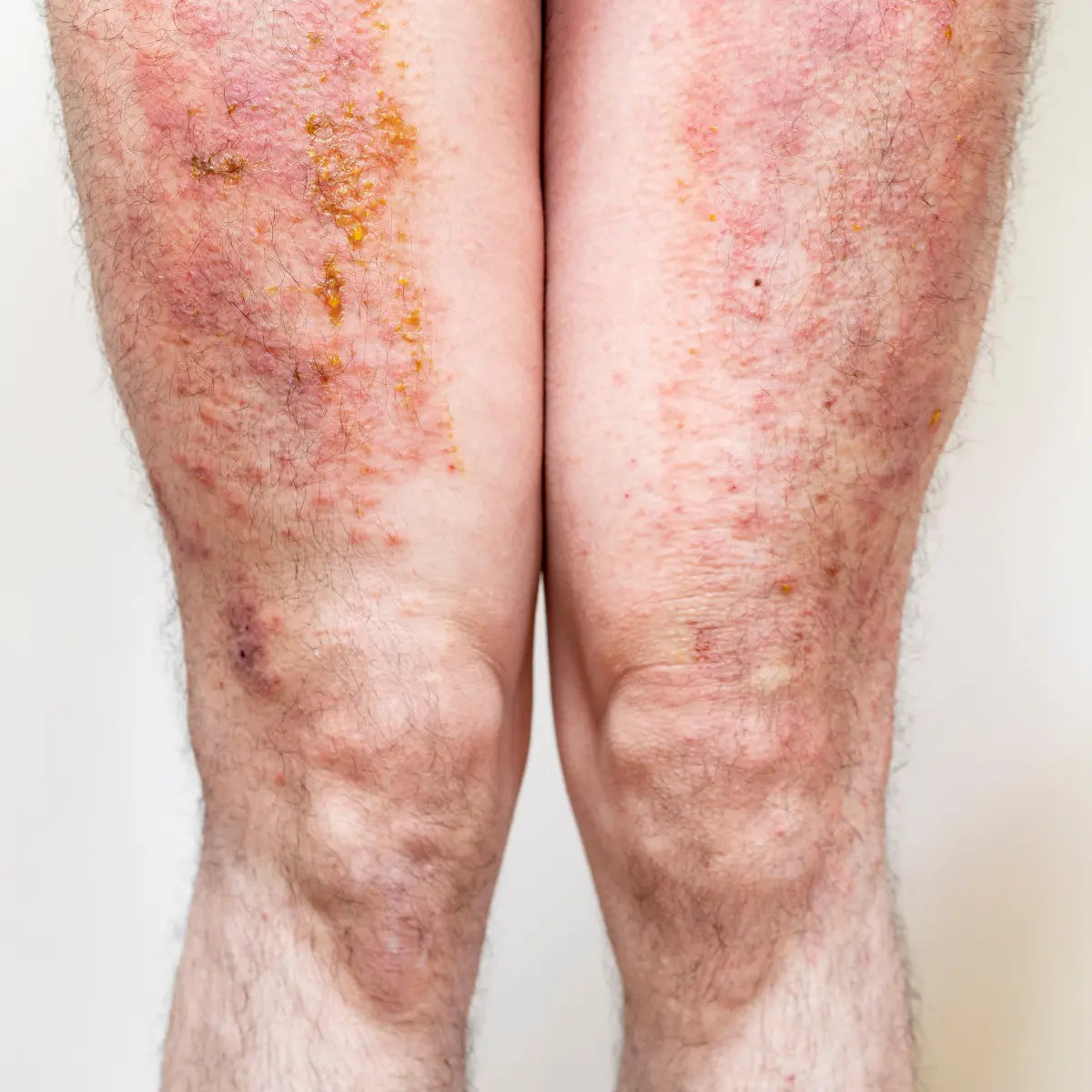 Is QICAOGANGMU Steroid-Free? A Transparent Look at Its Herbal Ingredients (2026)