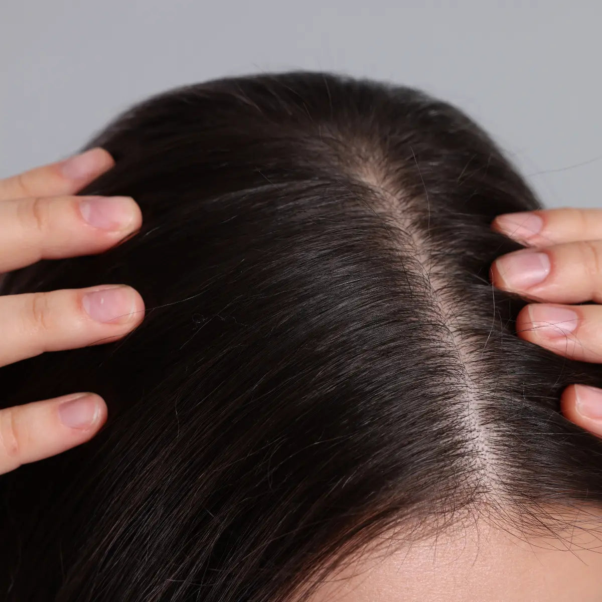 Scalp Itching and Dandruff: How QICAOGANGMU Helps Seborrheic Dermatitis (2026)