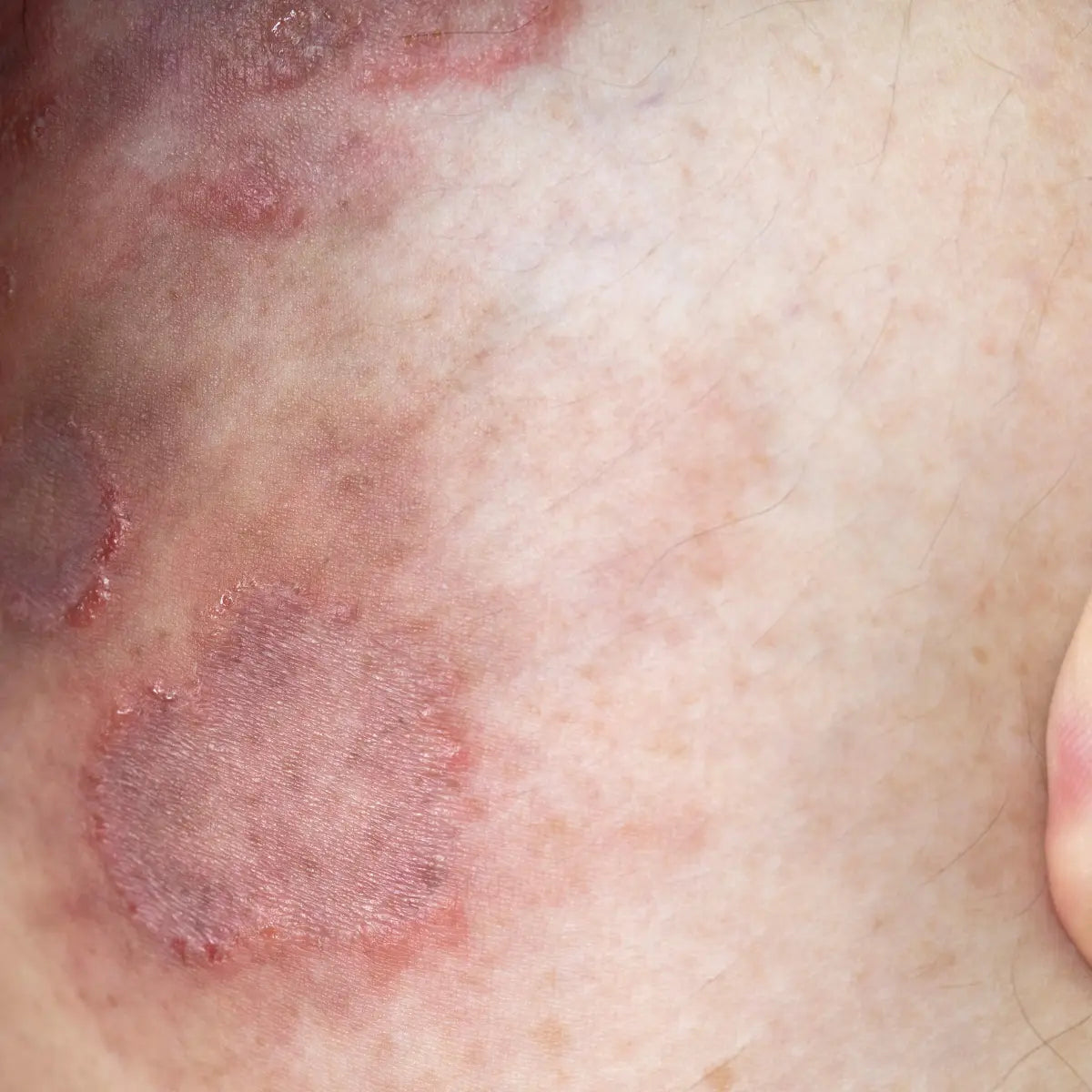 Ringworm Relief with QICAOGANGMU: A TCM Approach to Fungal Infections