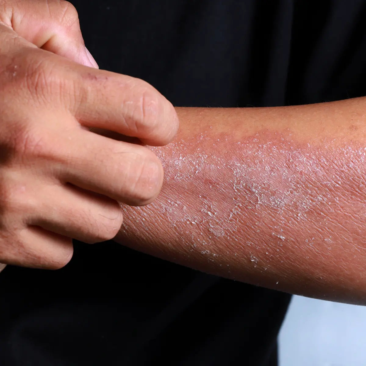 Person scratching dry, flaky eczema on the forearm