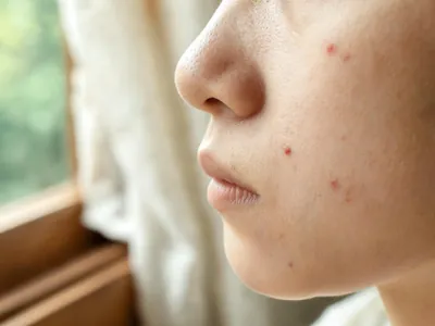 Acne: a calm illustration of the appearance