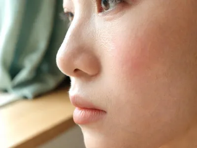 Rosacea: a calm illustration of the appearance