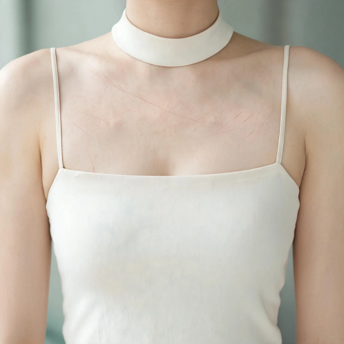 Clinical photograph of the upper chest and breast area of an adult wearing a high-neck cream camisole, with dry scratch marks on the upper breast. No face, nipple or intimate detail is shown.