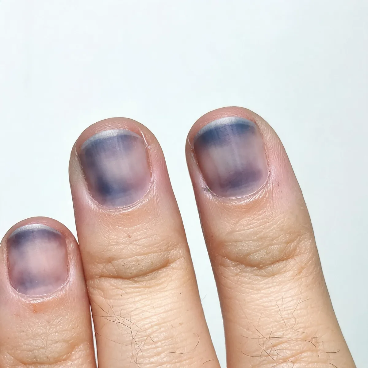 Fingertips and nail beds of a hand showing dusky blue-purple discolouration of the nail beds and skin, no other hand visible, no identity.
