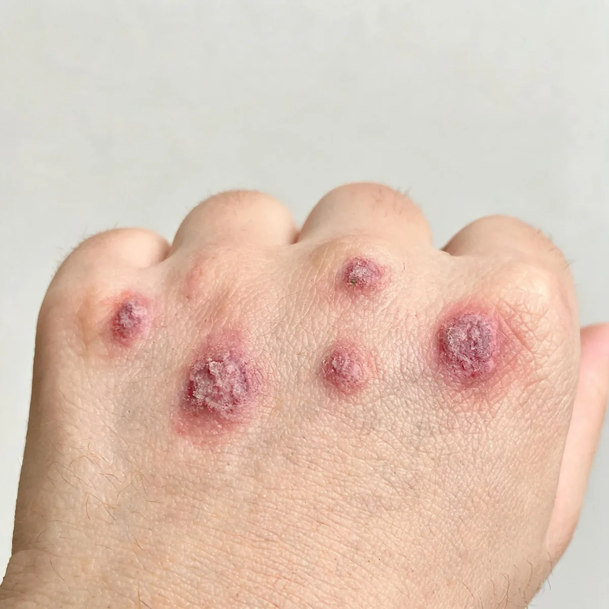 Back of the hand showing violet-red scaly papules over the knuckles, Gottron papules, with mild surrounding erythema.