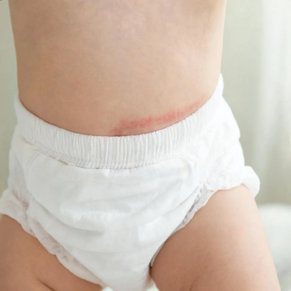 Clinical photograph of a baby's waist and diaper area, with a red rash along the waistband. No face or genital detail is shown.