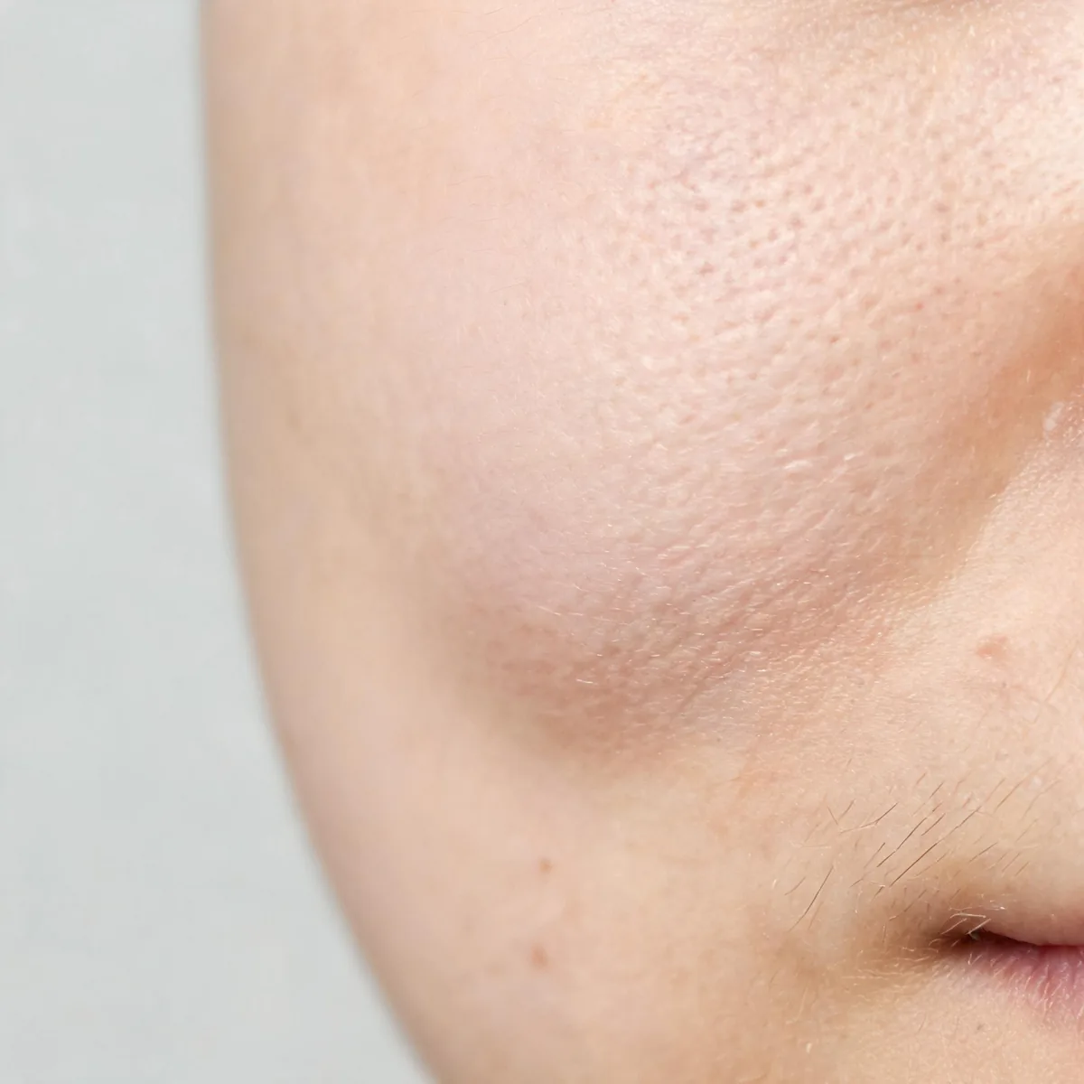 Lower face and jawline only, showing soft puffy swelling of the cheek and under-eye area, no eyes and no identity.
