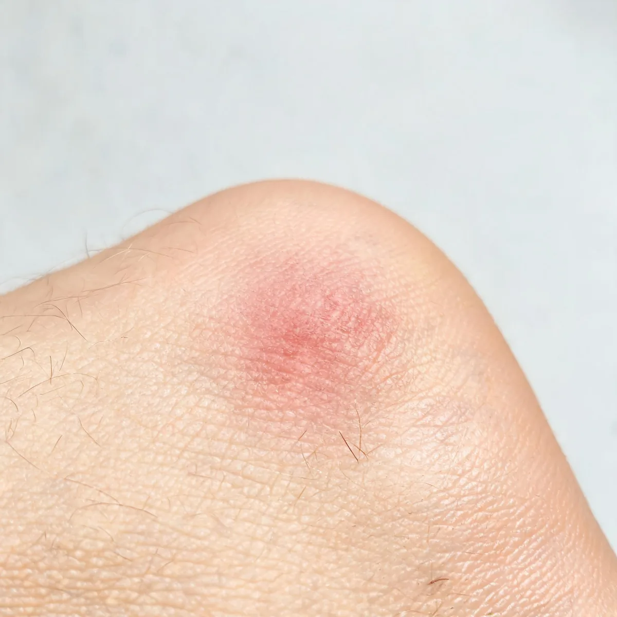 Top of the foot showing a red, mildly swollen area of skin with a poorly defined edge and no wound.