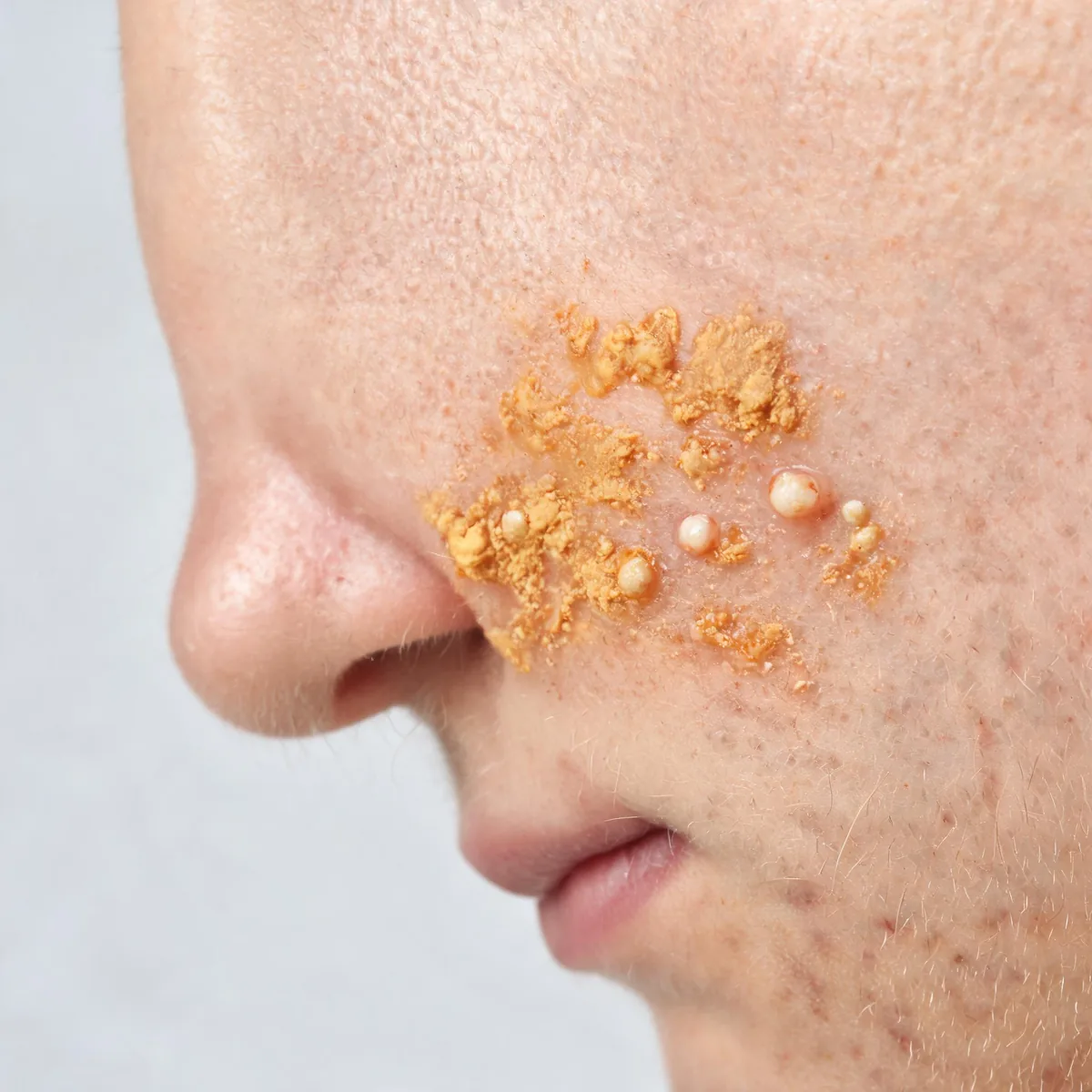 Skin around the nose and upper lip showing honey-coloured crusted lesions with a few intact pustules, impetigo, no face above the nose.