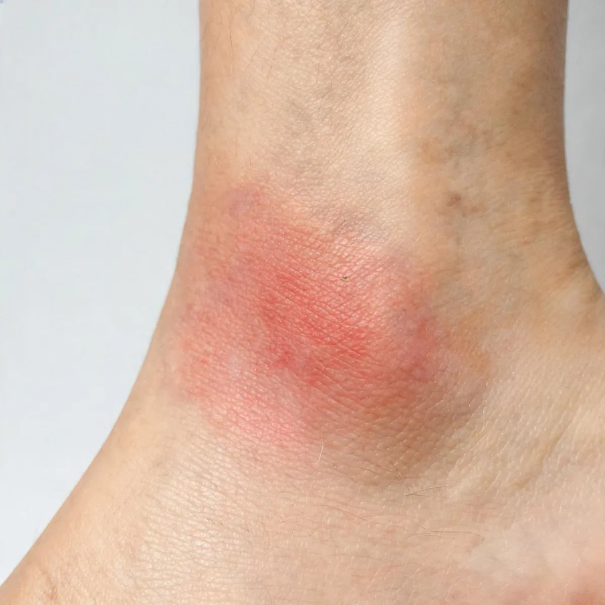 Outer ankle showing red, swollen, warm skin over the lateral malleolus with a poorly defined border, no wound.