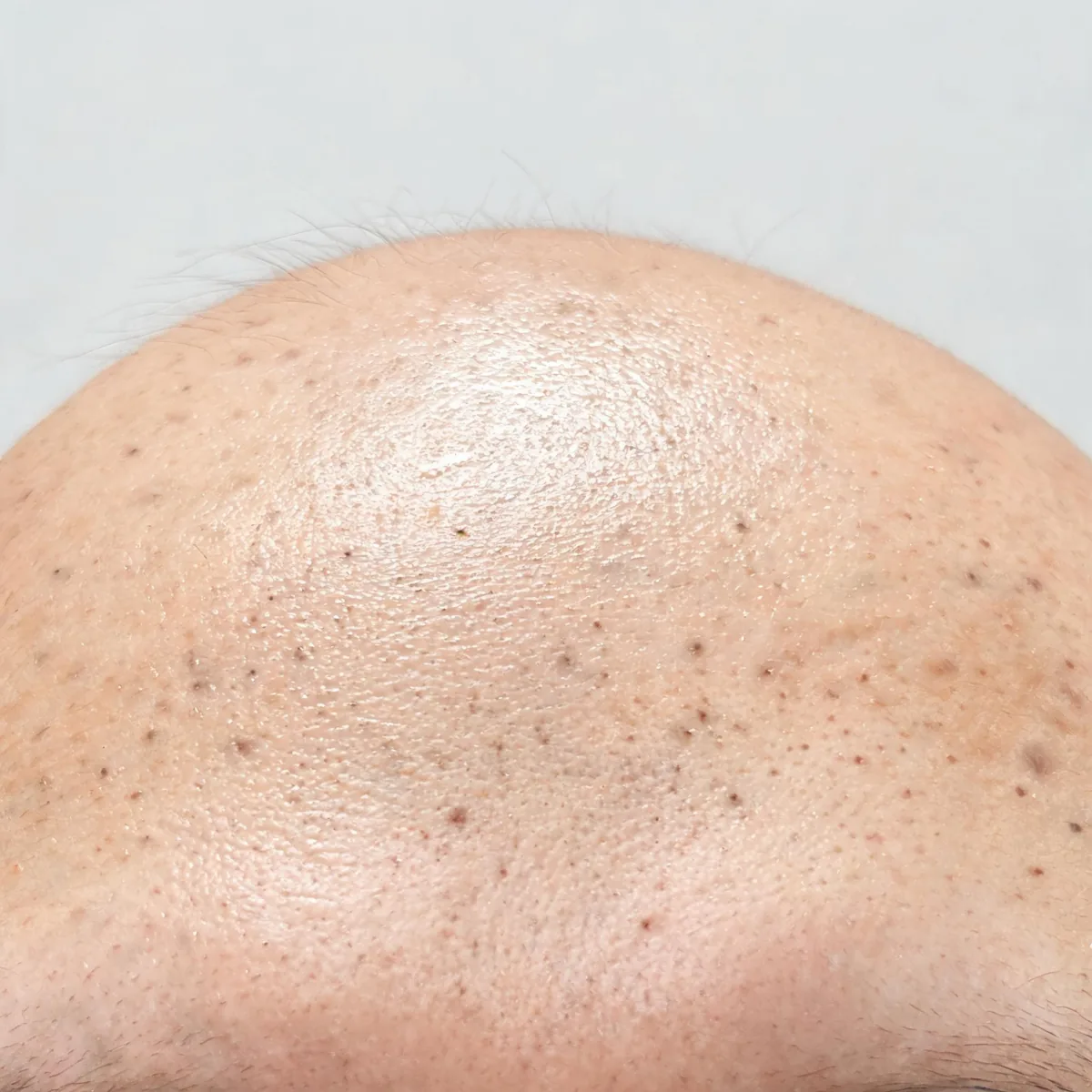 Skin of the forehead showing an oily sheen and visible pores, no acne and no lesion.