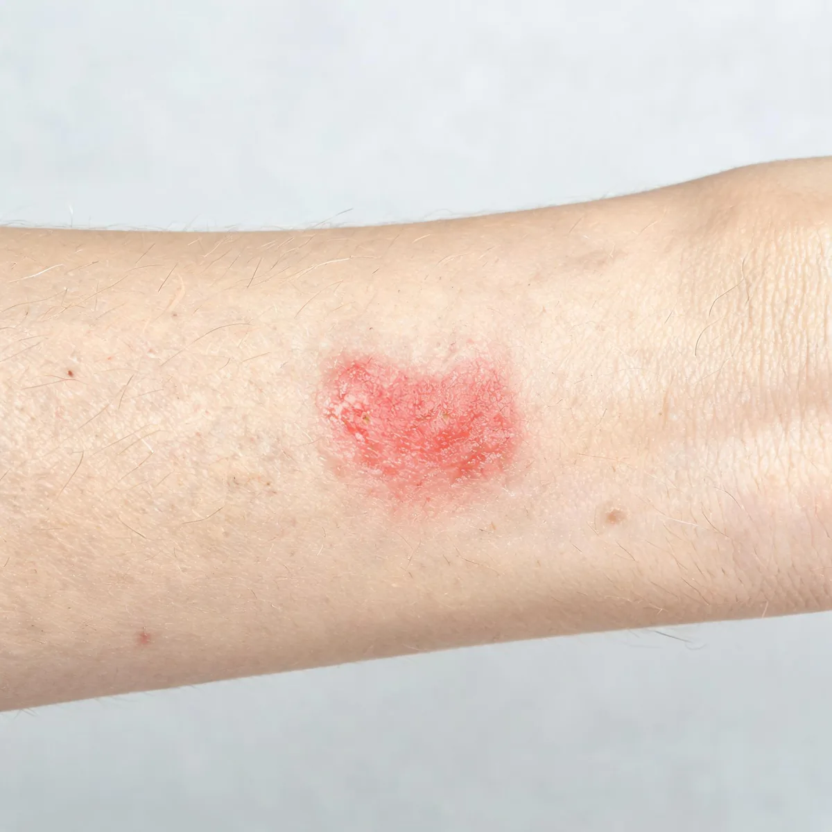 Outside of a forearm showing a superficial red erosion where the top skin layer is lost, moist surface, no ulcer crater and no blood.