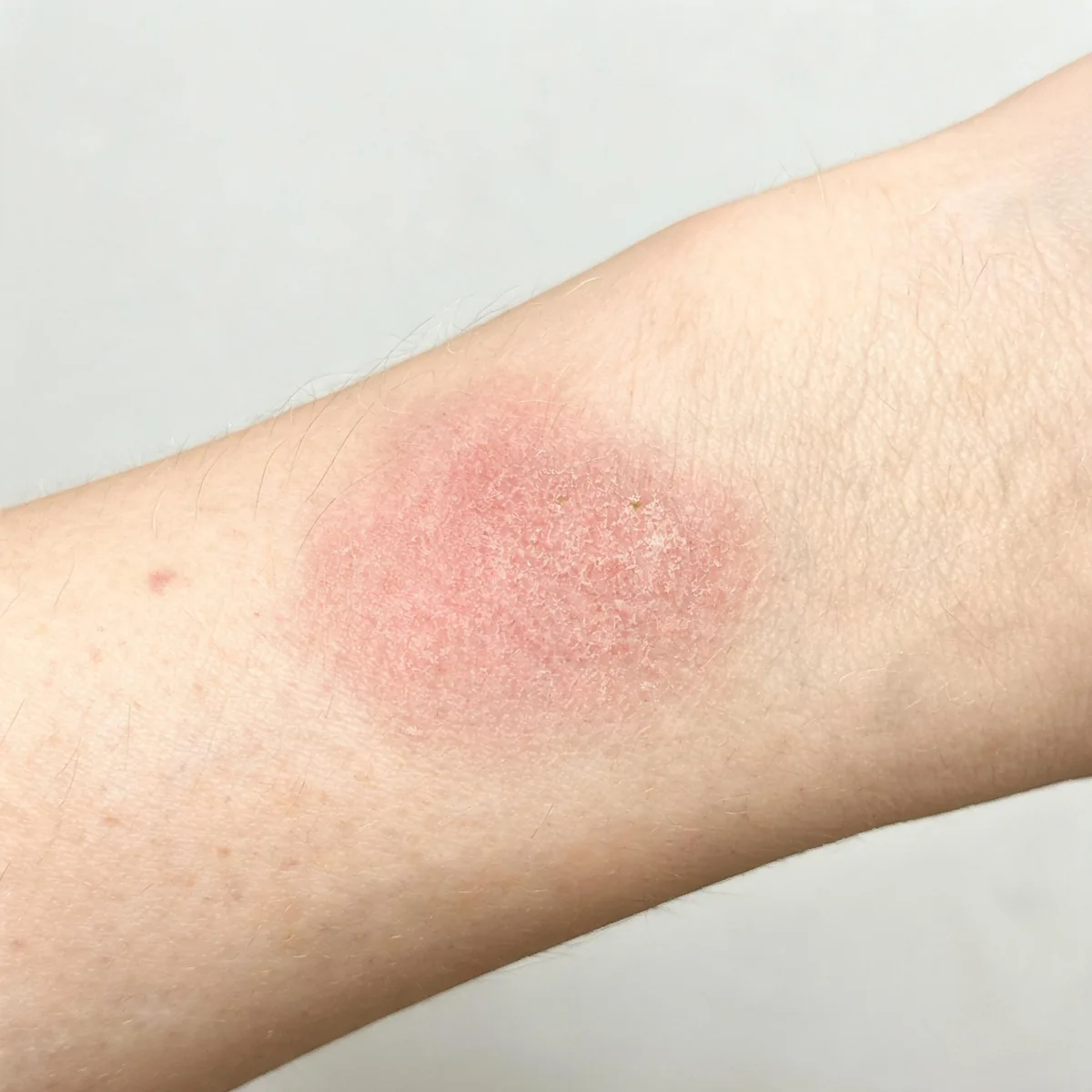 Inner forearm showing mildly red, sensitive-looking skin with fine scaling and no rash, on the inner forearm.