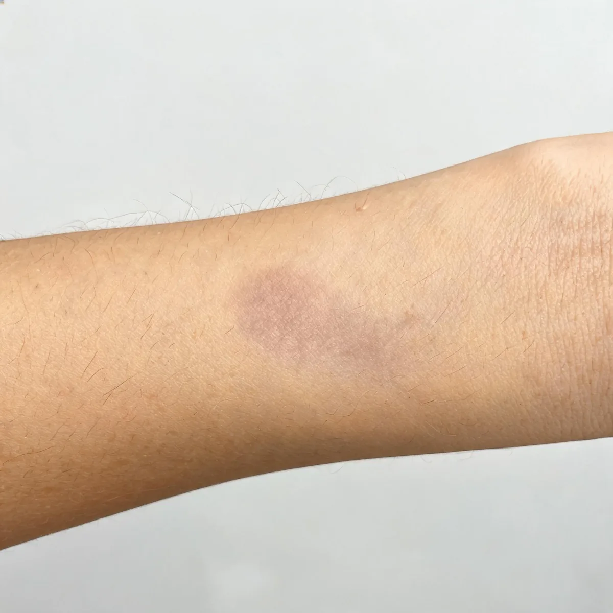 Skin of the forearm showing normal skin colour and texture with no rash or lesion, no visible sensory change.
