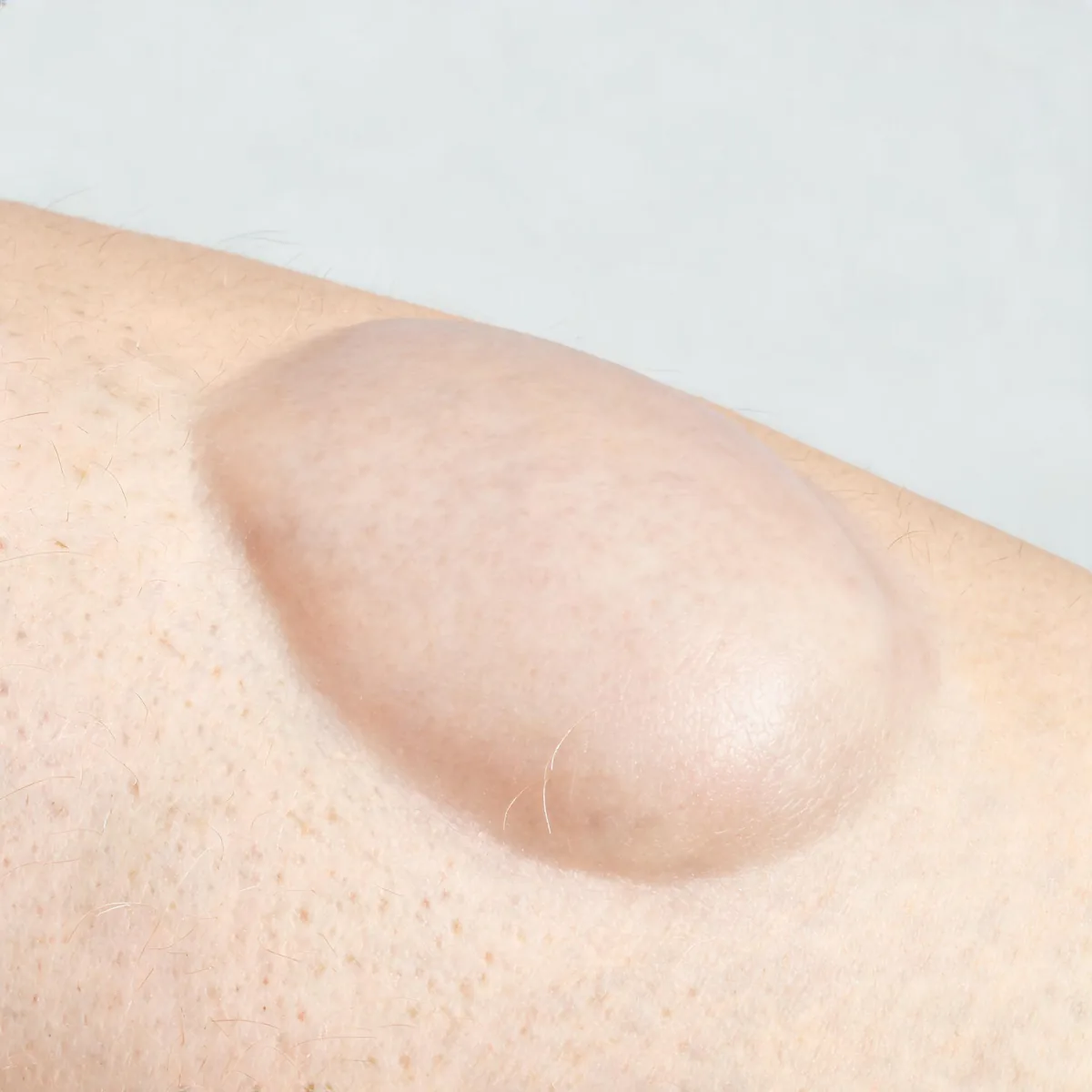 Flank showing an area of pale puffy swelling of the skin with a smooth stretched surface and no redness.