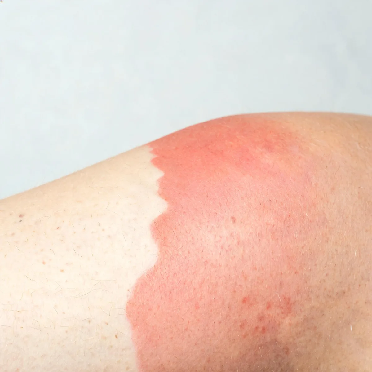 5 Patterns 9 Herbs 5 Formulas 10 Acupoints 5 Related Print or save this page as PDF Skin Conditions Injuries, Burns Wounds A close.
