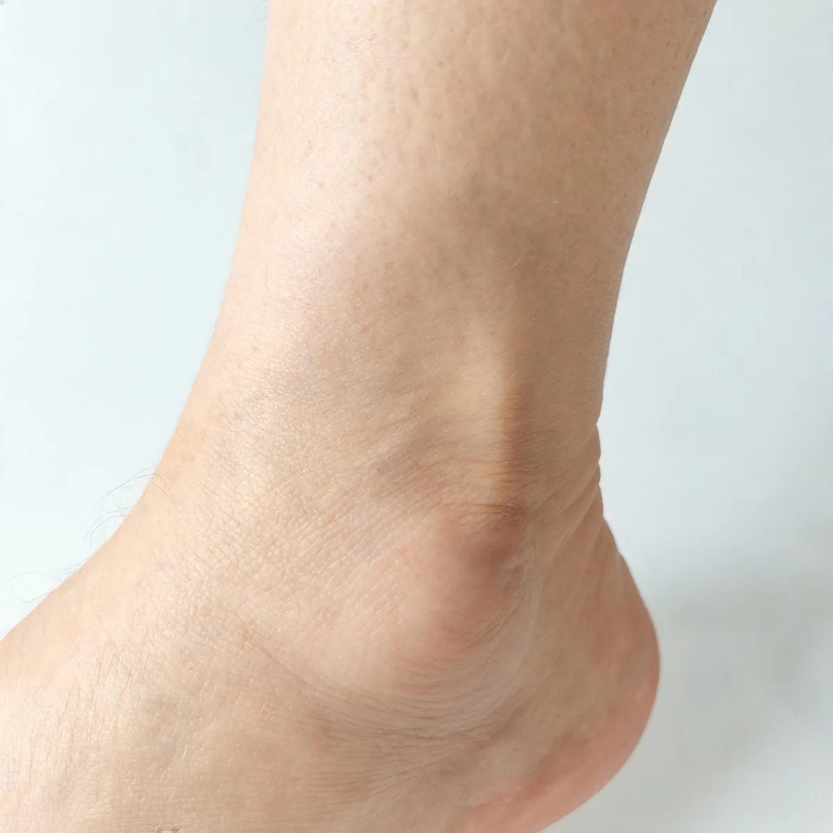 Ankle from the side showing soft tissue swelling around the joint with normal skin colour and no bruising.