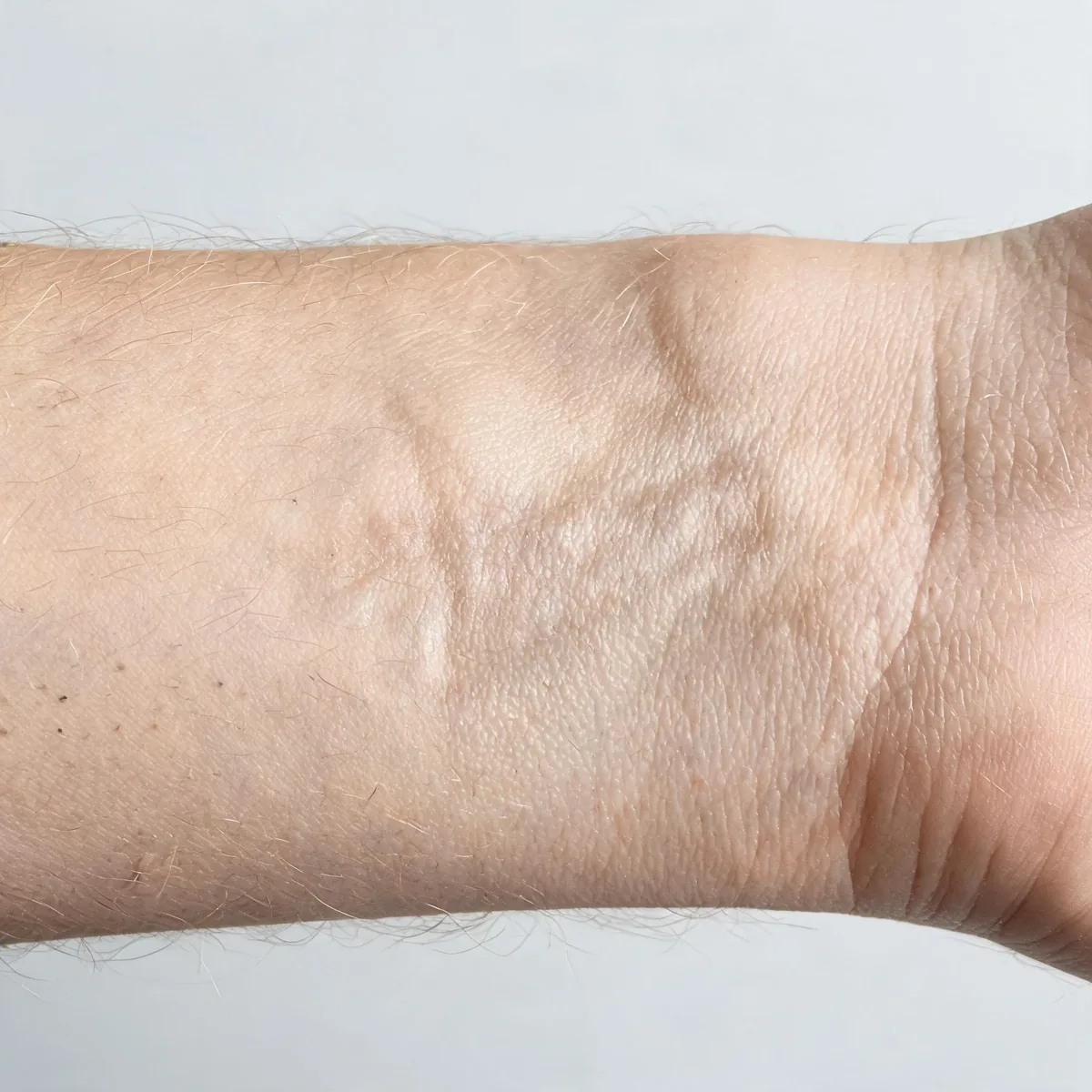 Inner forearm showing thickened, hardened, slightly shiny skin with loss of normal texture and reduced creases, no rash.