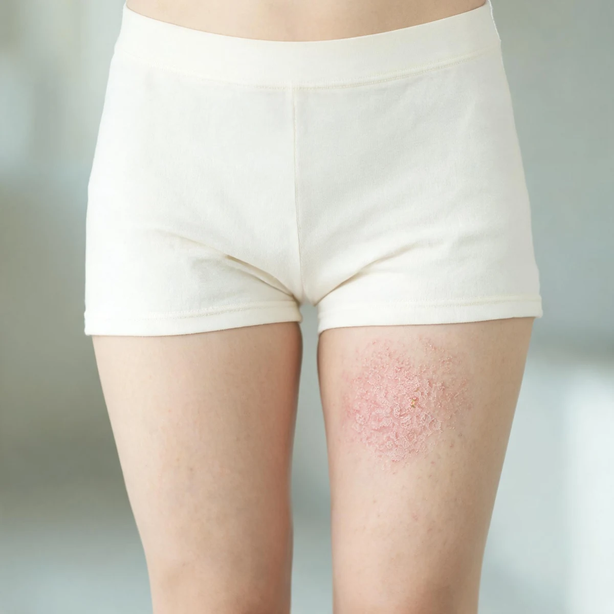 Clinical photograph of the lower abdomen and upper thighs in high-waisted cream shorts, with a dry pink lichenified patch on the upper inner thigh. No genital or intimate detail is shown.