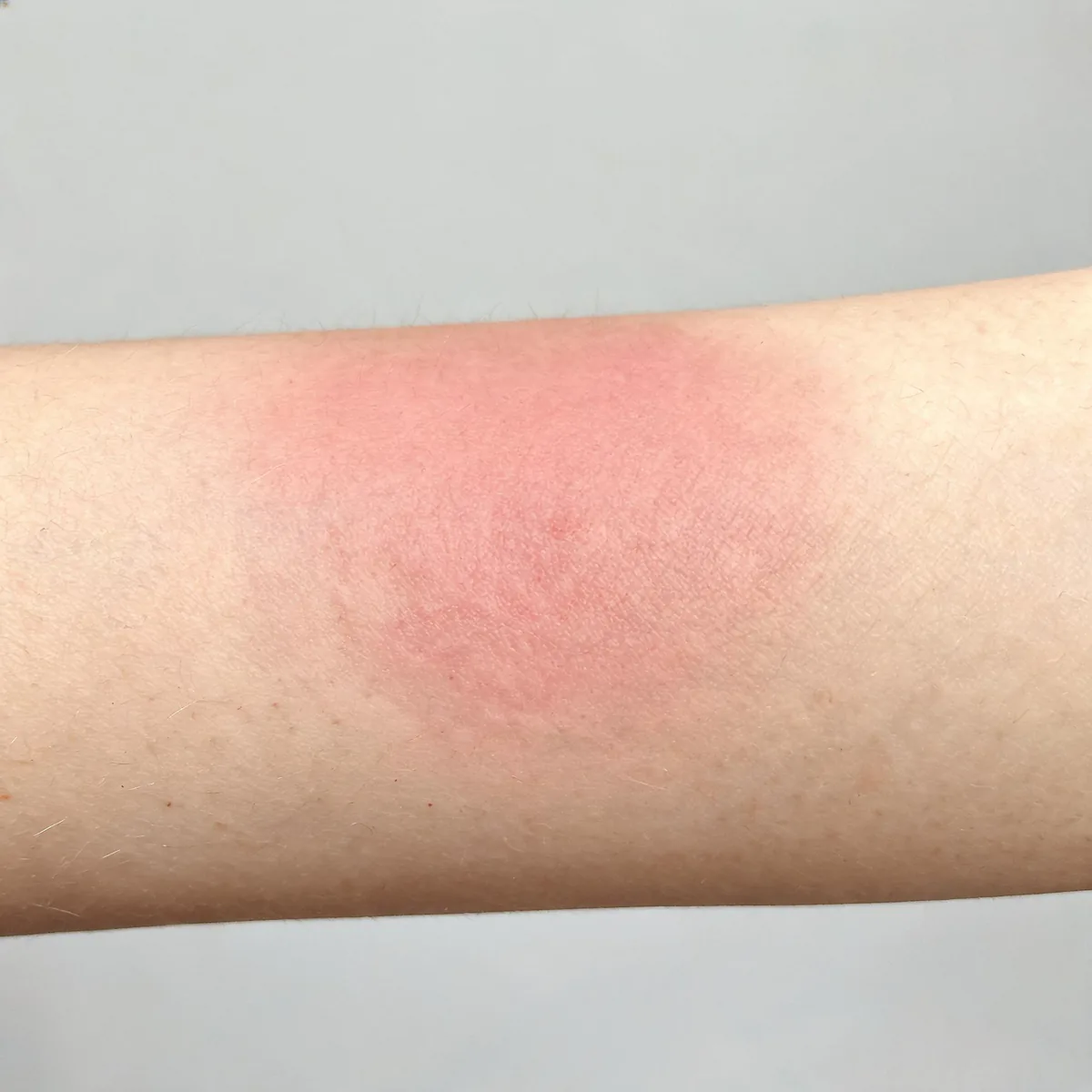 Skin of the forearm showing a diffuse warm pink flush with normal texture and no rash.